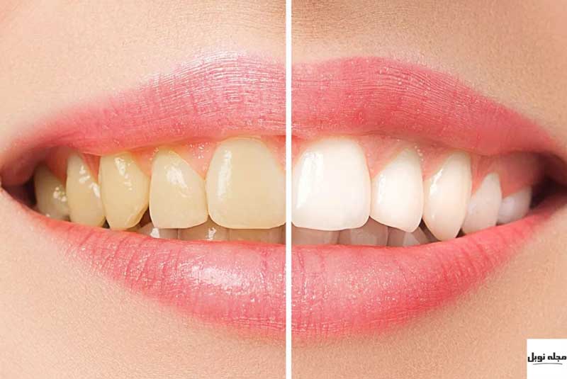 سفید کردن دندان زرد