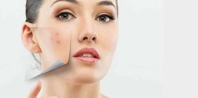 بهترین پماد برای جوش صورت