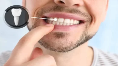 مراقبت های ایمپلنت
