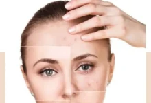 پاکسازی پوست چرب و جوش دار با سالن زیبایی شبنم نظیف